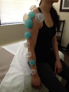Myofascial Cupping