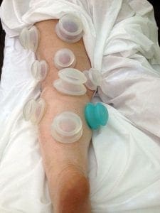 Myofascial Cupping